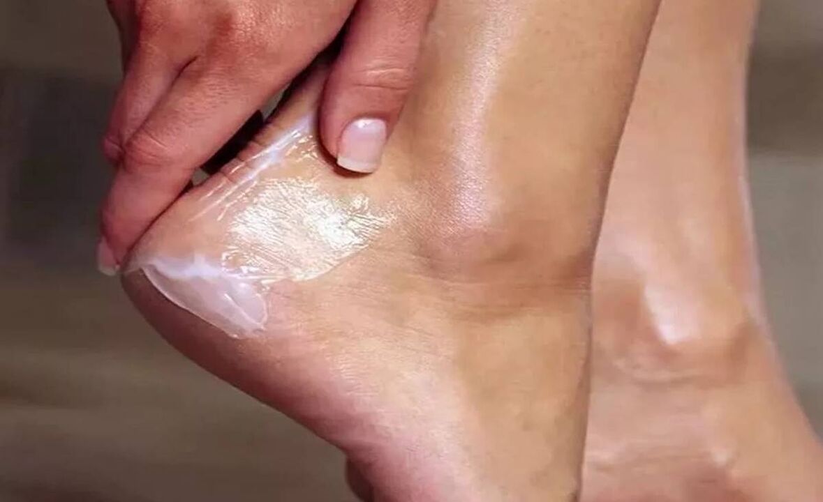 Wie man Fußpilz mit Pilzcreme behandelt