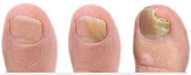 Stufen der Nagelpilzentwicklung