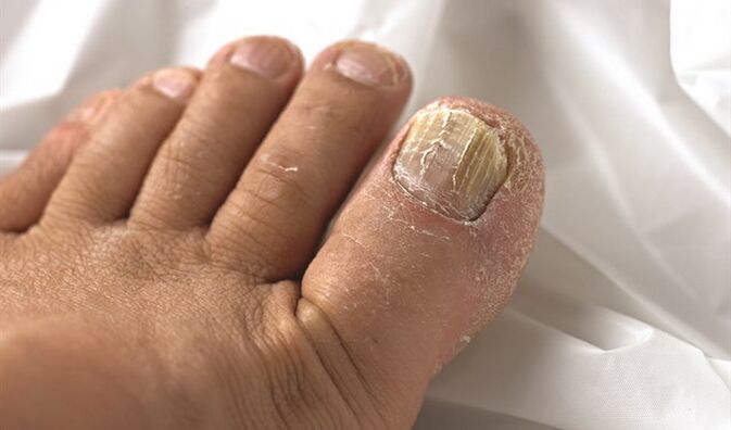 Strecken Sie die Myosel -Läsion auf die Nagelplatte aus