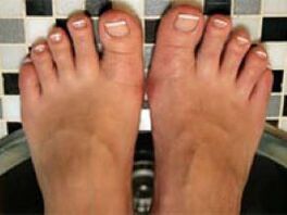 Nagelpilz und Beinhaut
