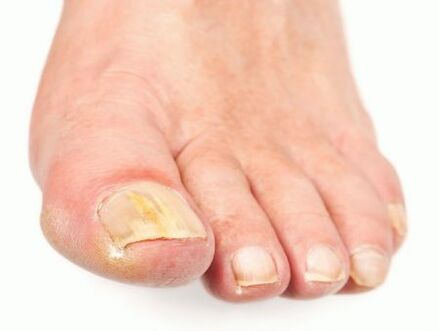 Nagelpilzschäden