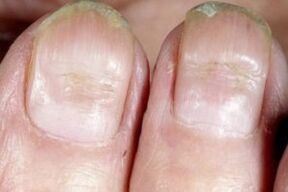 Symptome von Nagelpilz