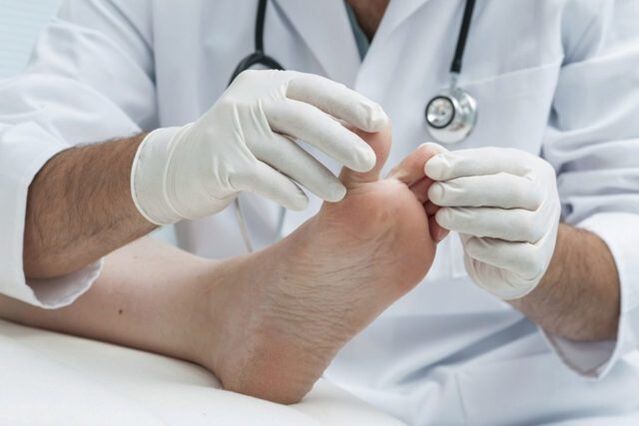 Diagnose von Fußpilz durch einen Arzt