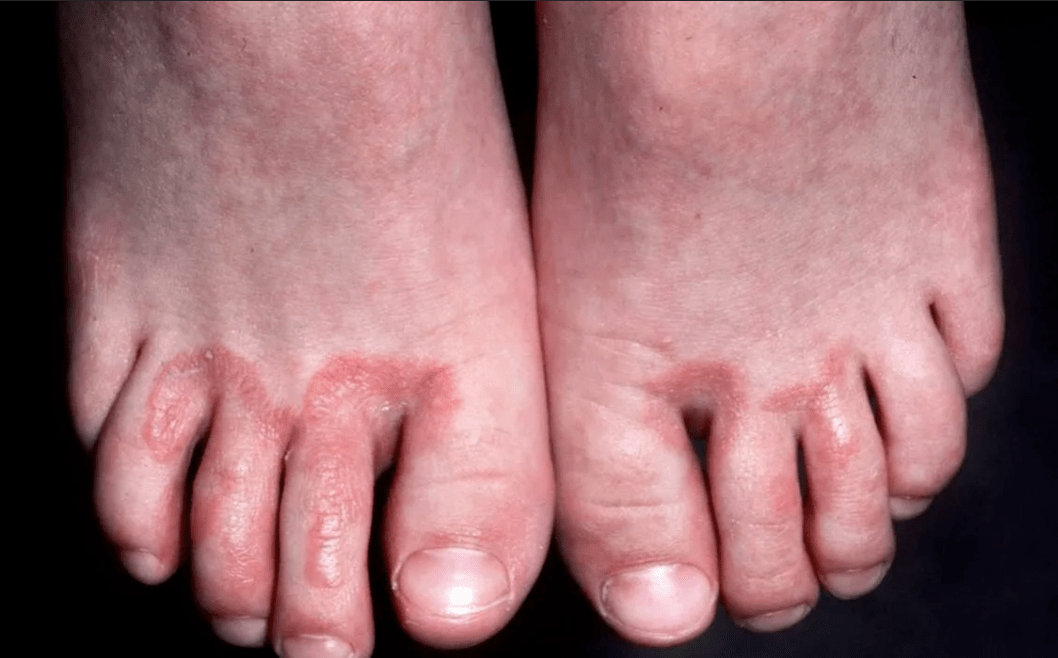 Komplikationen bei Nagelpilz