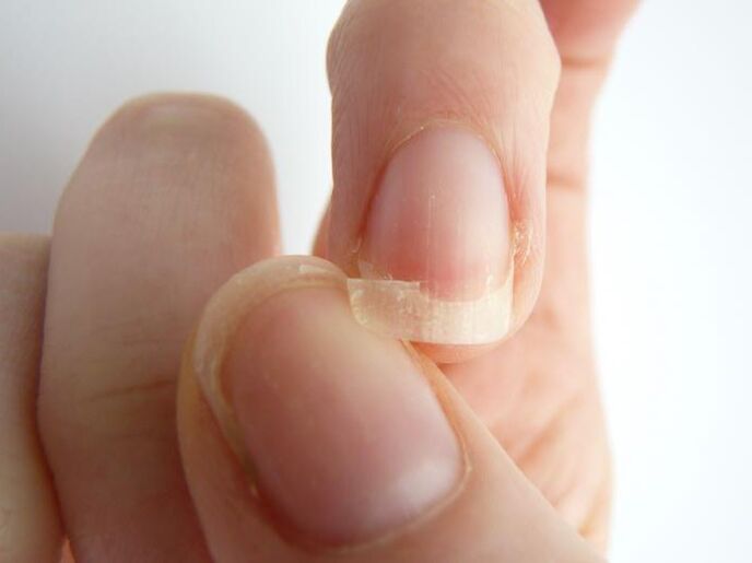 Nagelablösung durch Pilz.