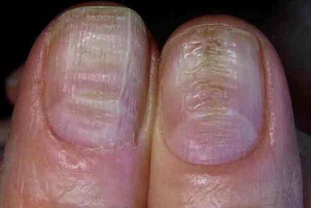 Pilzinfektion der Nagelplatte